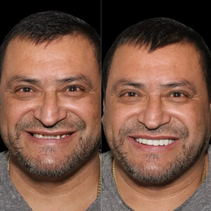 SMYLE patient transformation 1