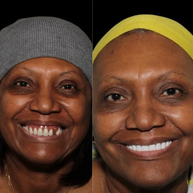 SMYLE patient transformation 3
