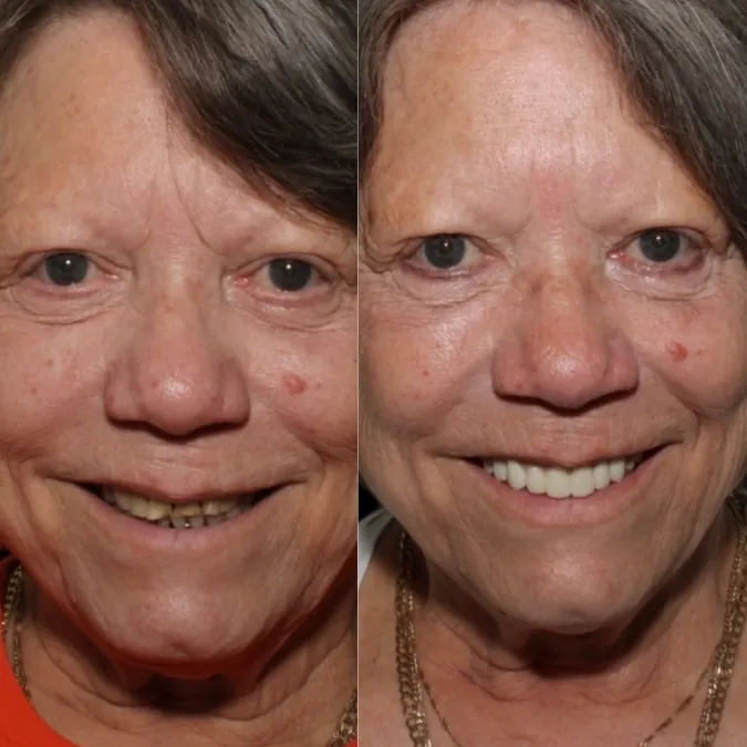 SMYLE patient transformation 5
