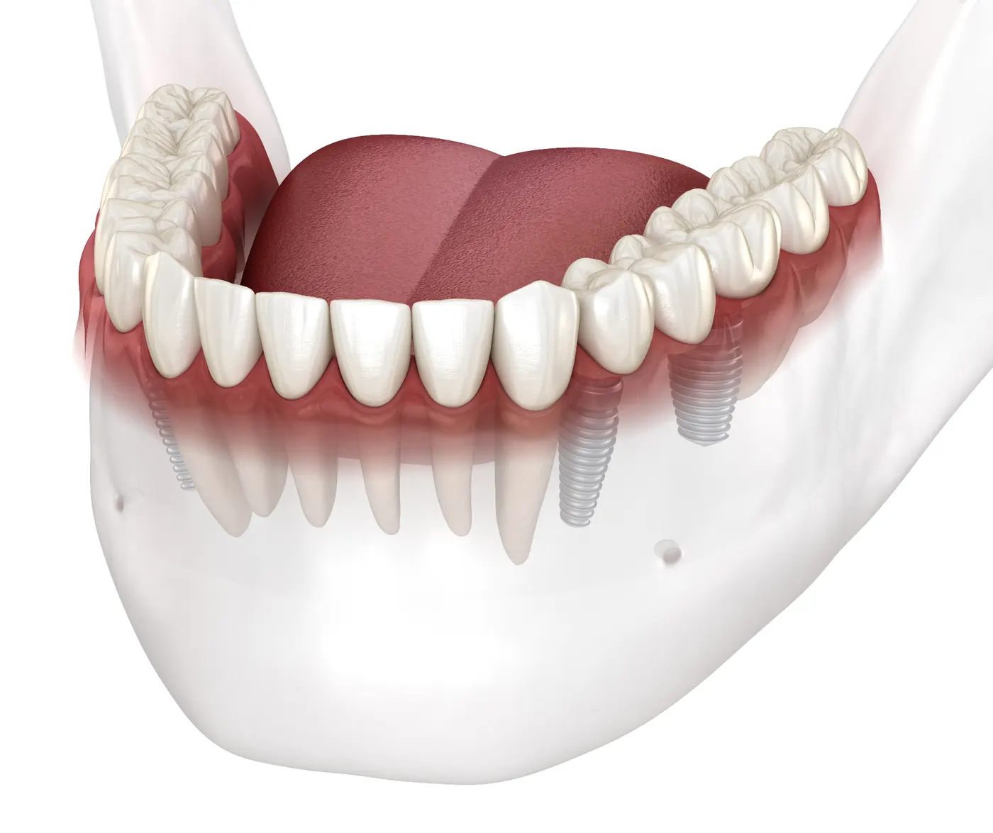 Pterygoid Dental Implants
