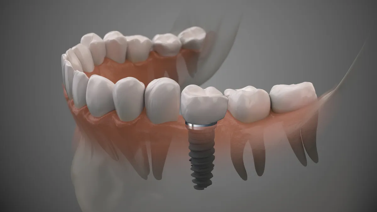Single Dental Implant
