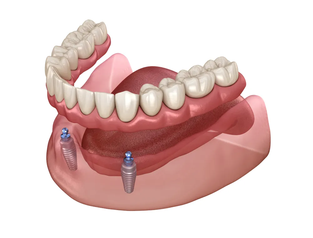Snap-On Denture Implants